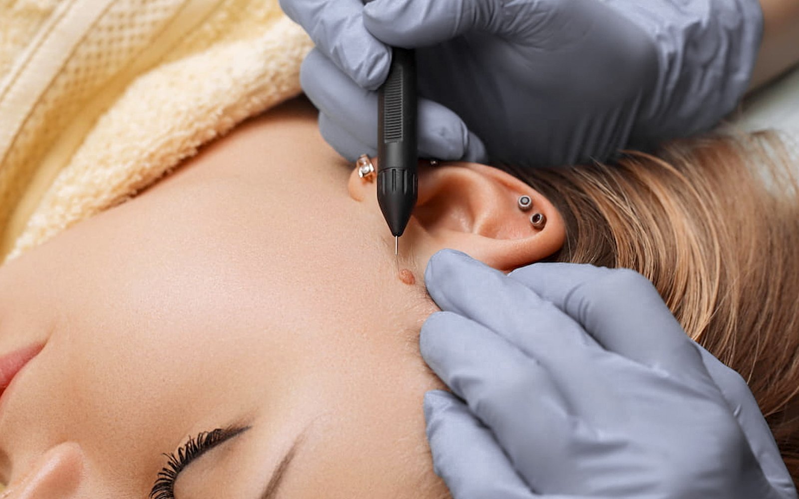 Profhilo-bioredensificacion