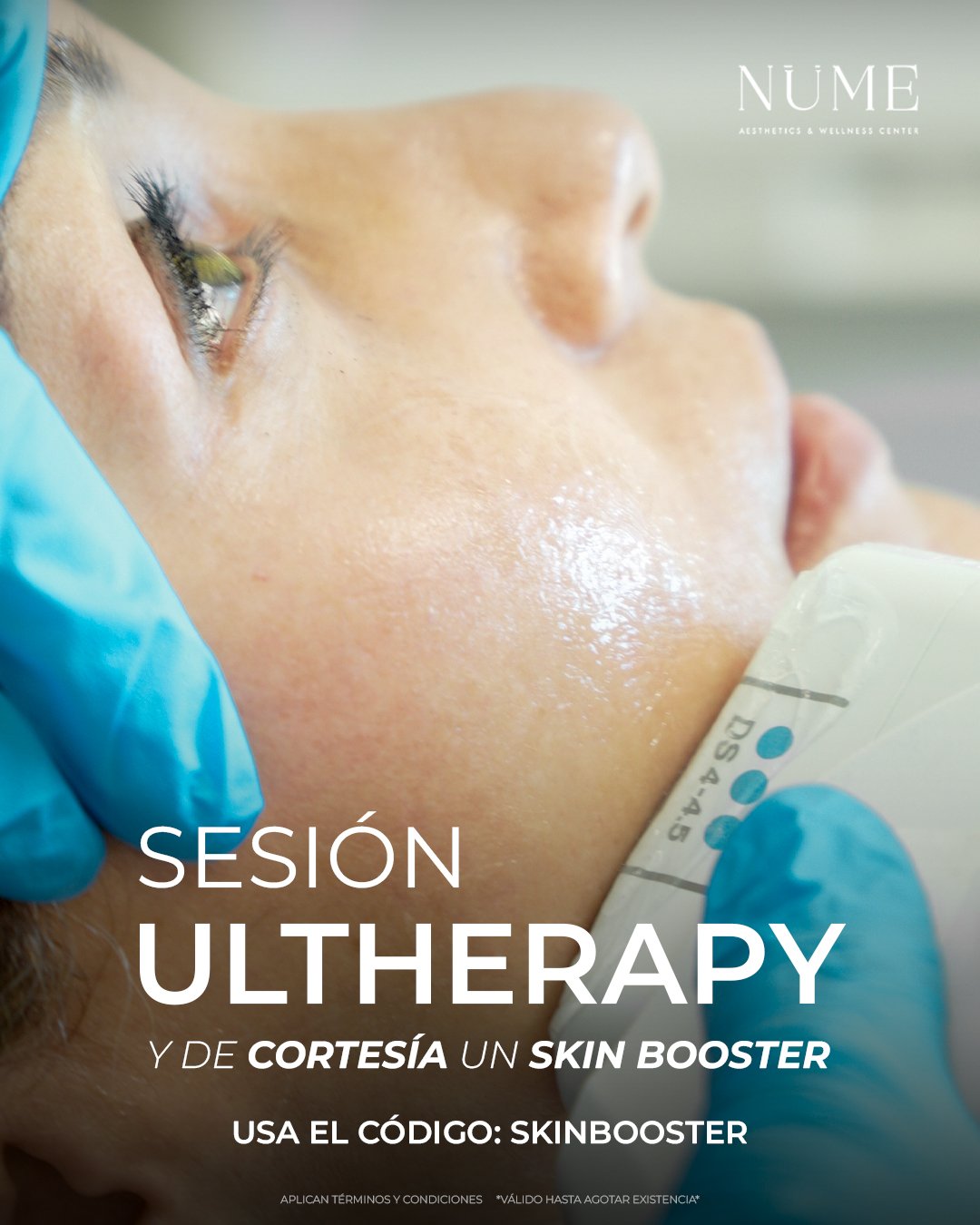 Promoción Ultherapy®