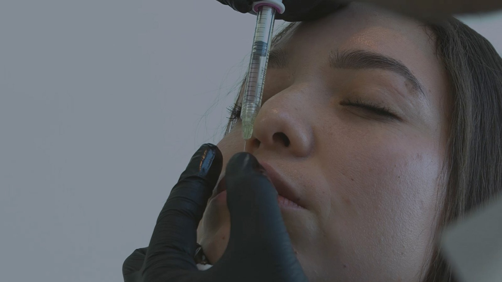 Lip augmentation