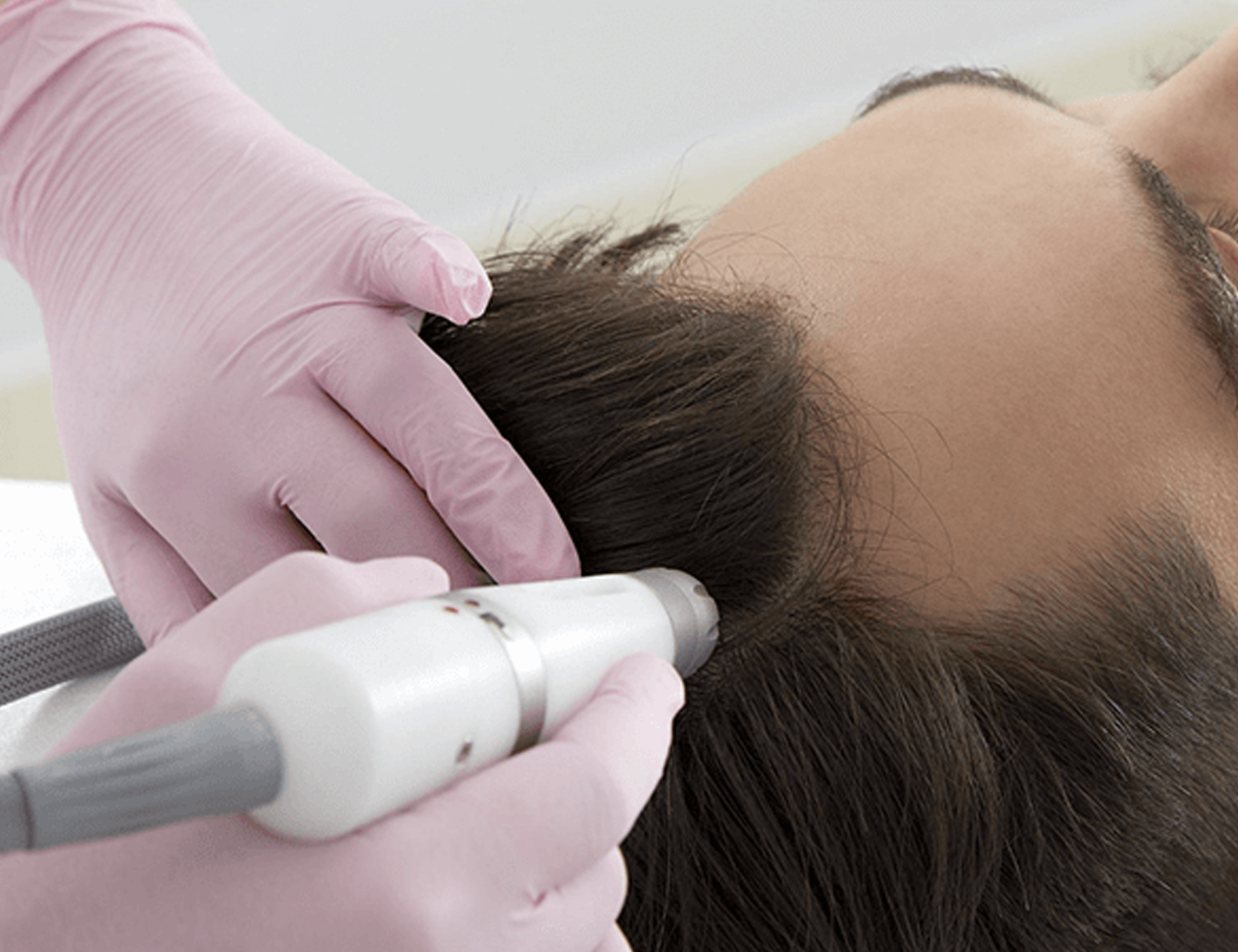 Capilar microneedling