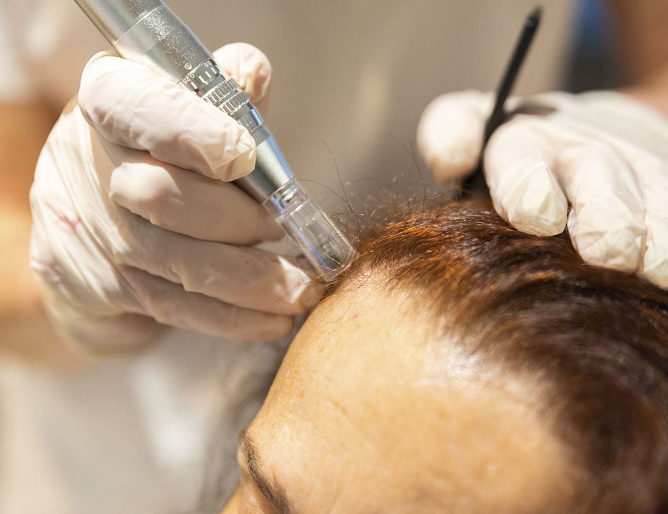 Capilar microneedling